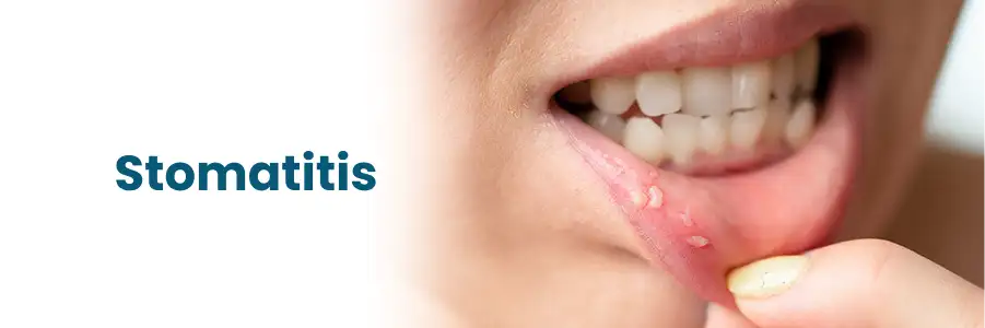 Stomatitis