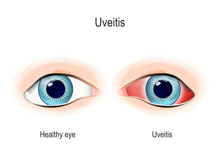 Uveitis