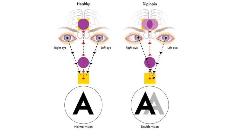 Diplopia
