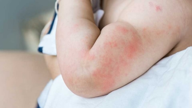 Gejala Demam Berdarah