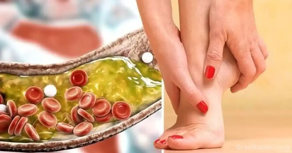 Gejala Kolesterol Tinggi