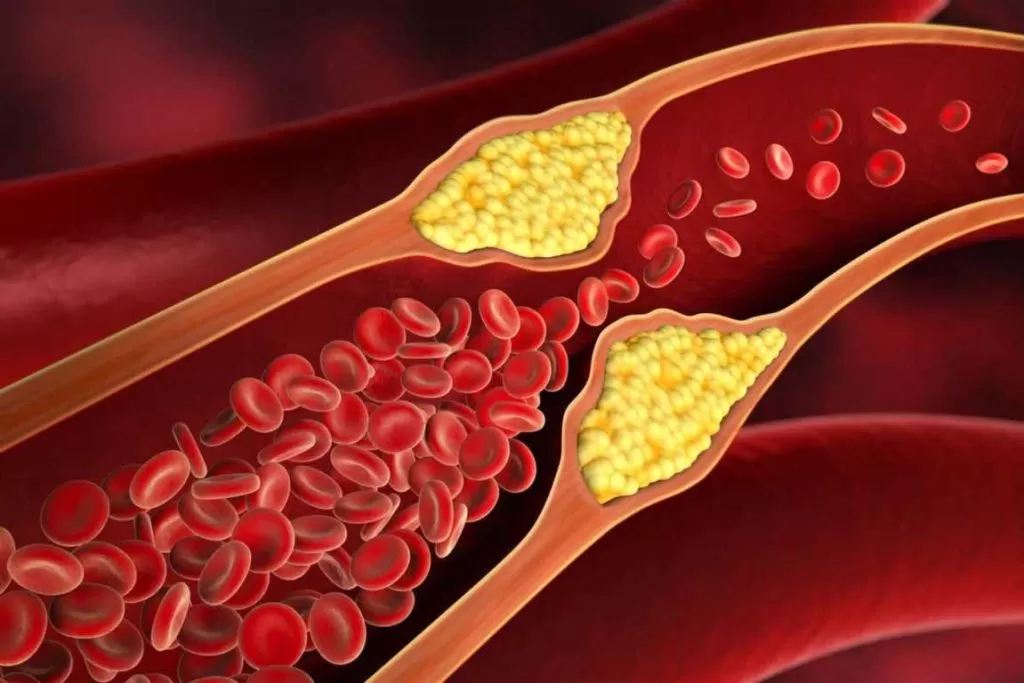 Gejala Kolesterol Tinggi