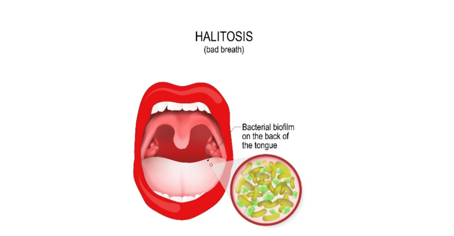 Halitosis