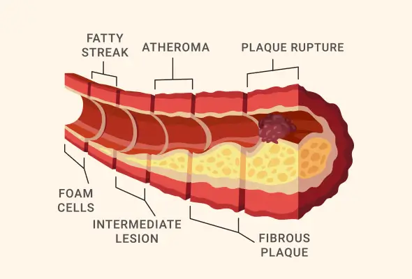 Aterosklerosis Arteri