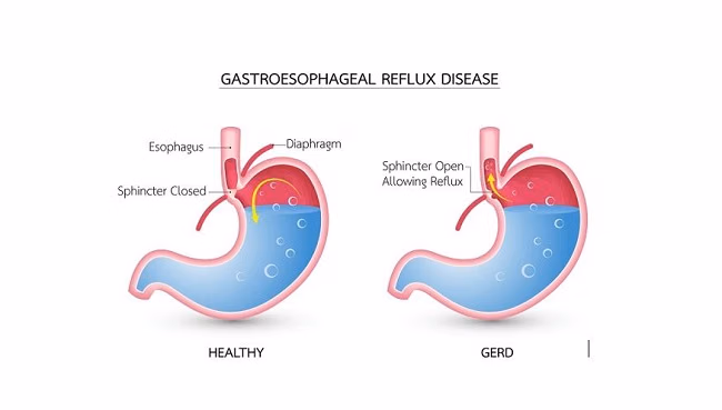Penyebab Gerd
