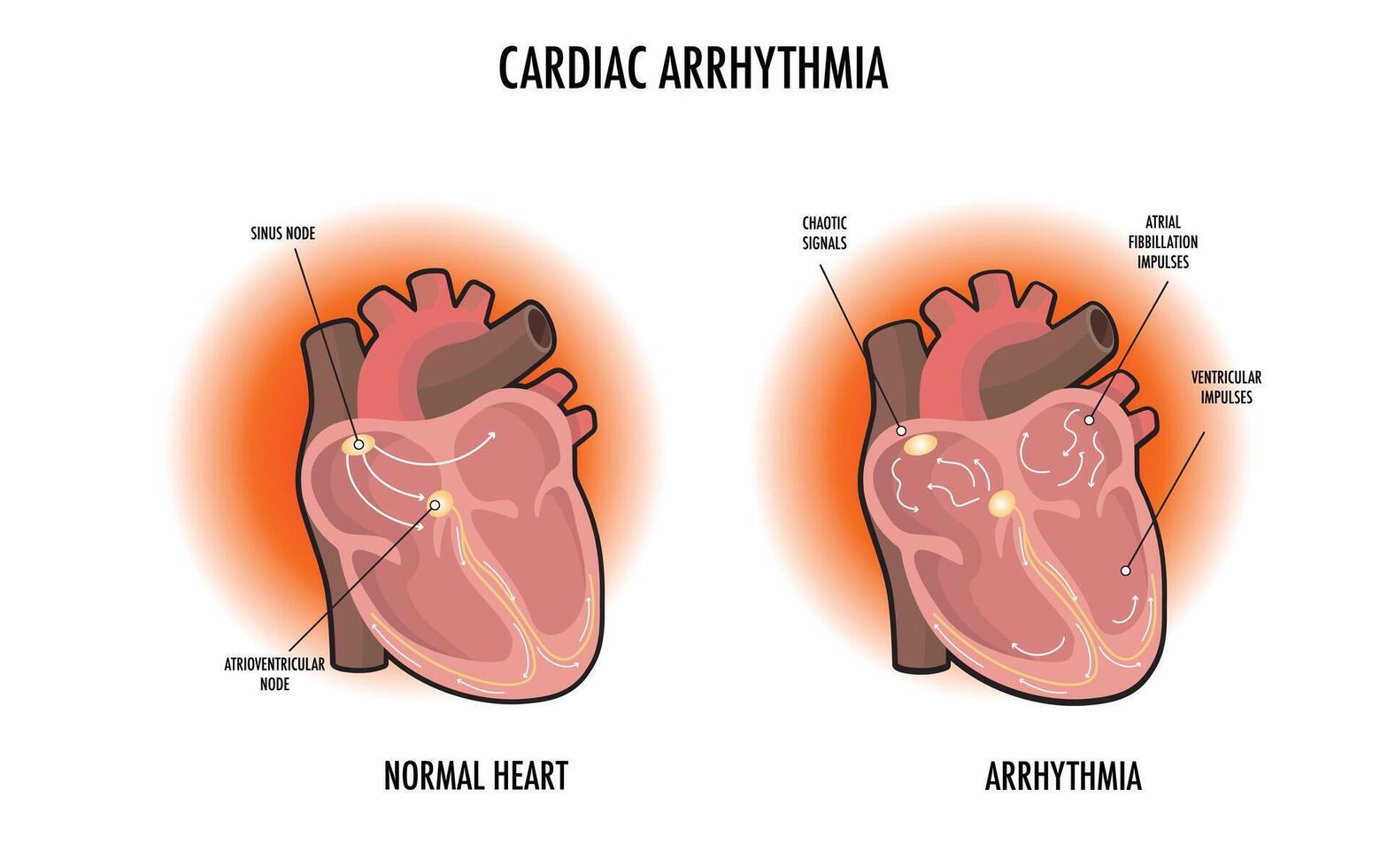 Cardiac Arrhythmia