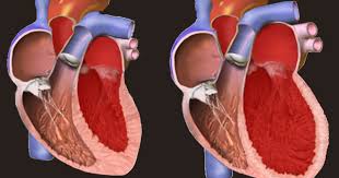 Kardiomiopati Dilatasi