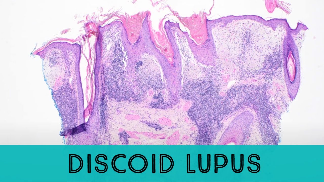 Discoid Lupus