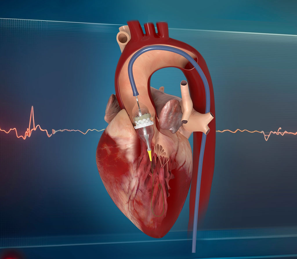 Aortic Valve Disease