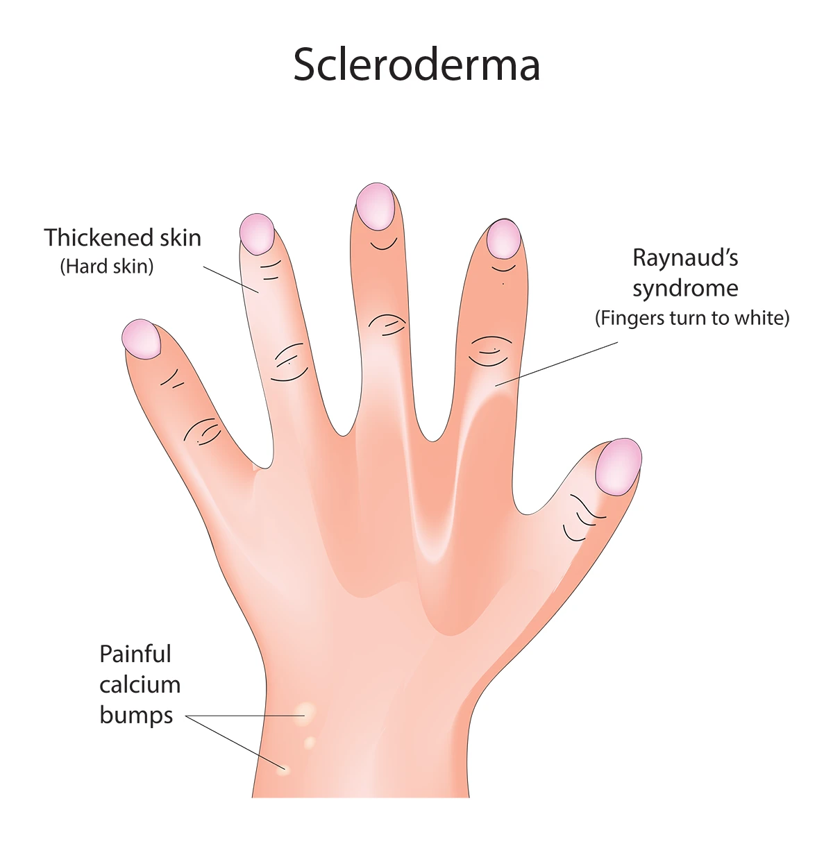 Scleroderma