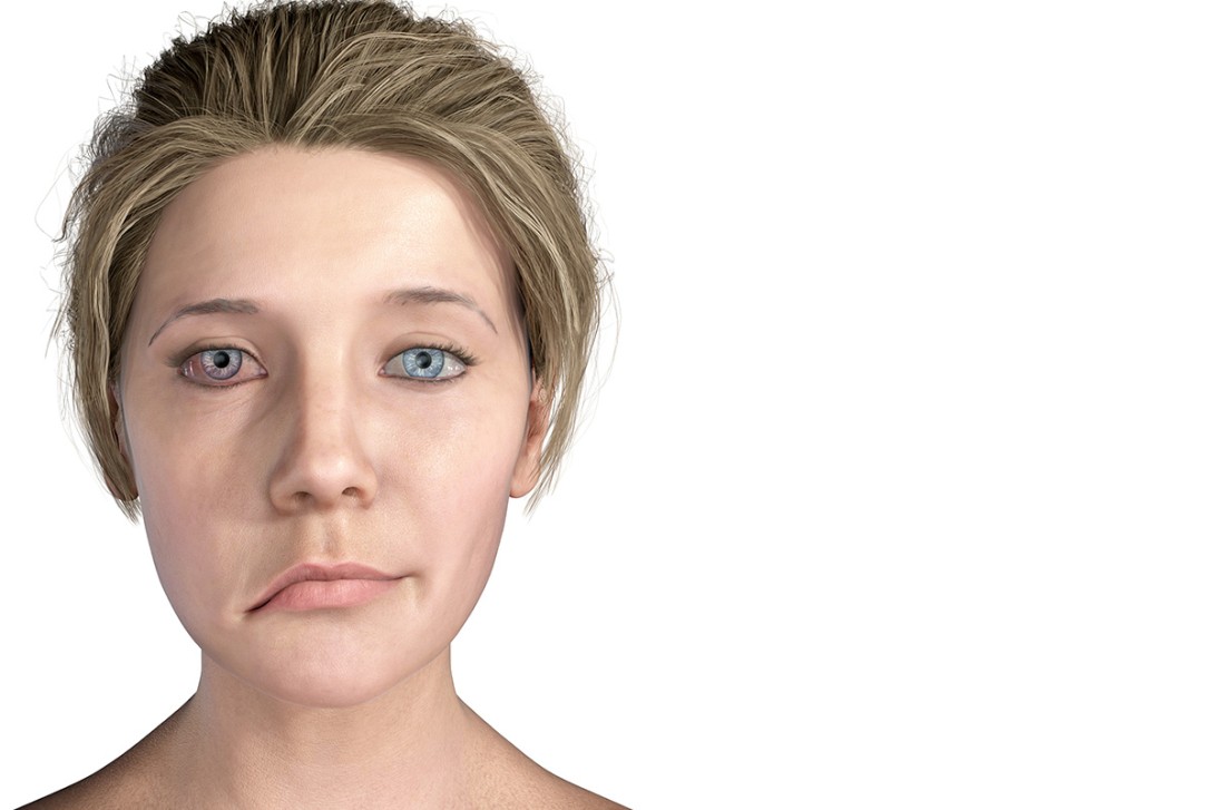 Bell's Palsy