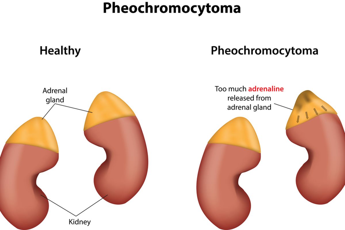Feokromositoma