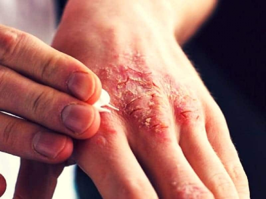 Kudis Scabies