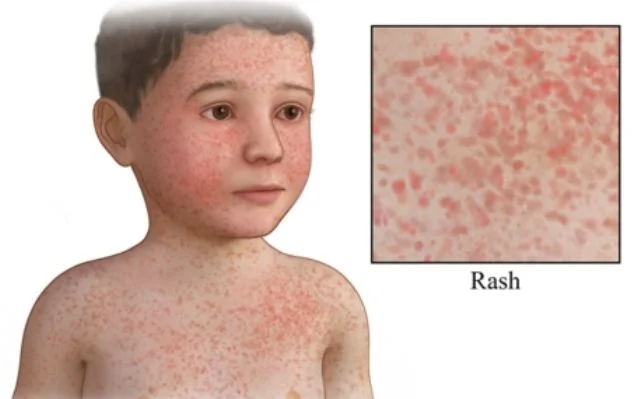 Rubella Ringan
