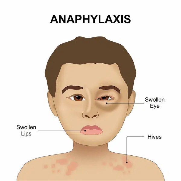 Anafilaksis