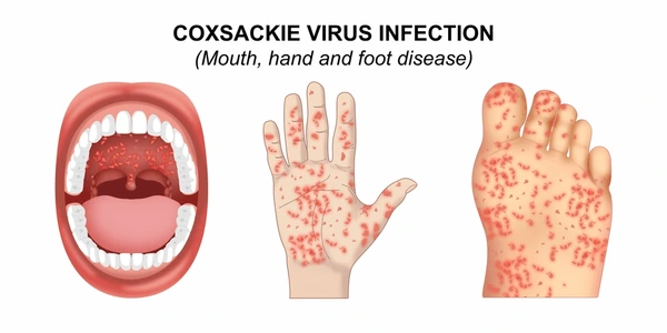 Coxsackie Virus