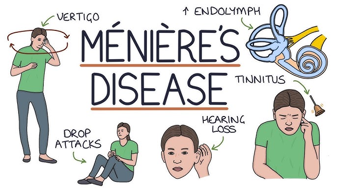Meniere Disease