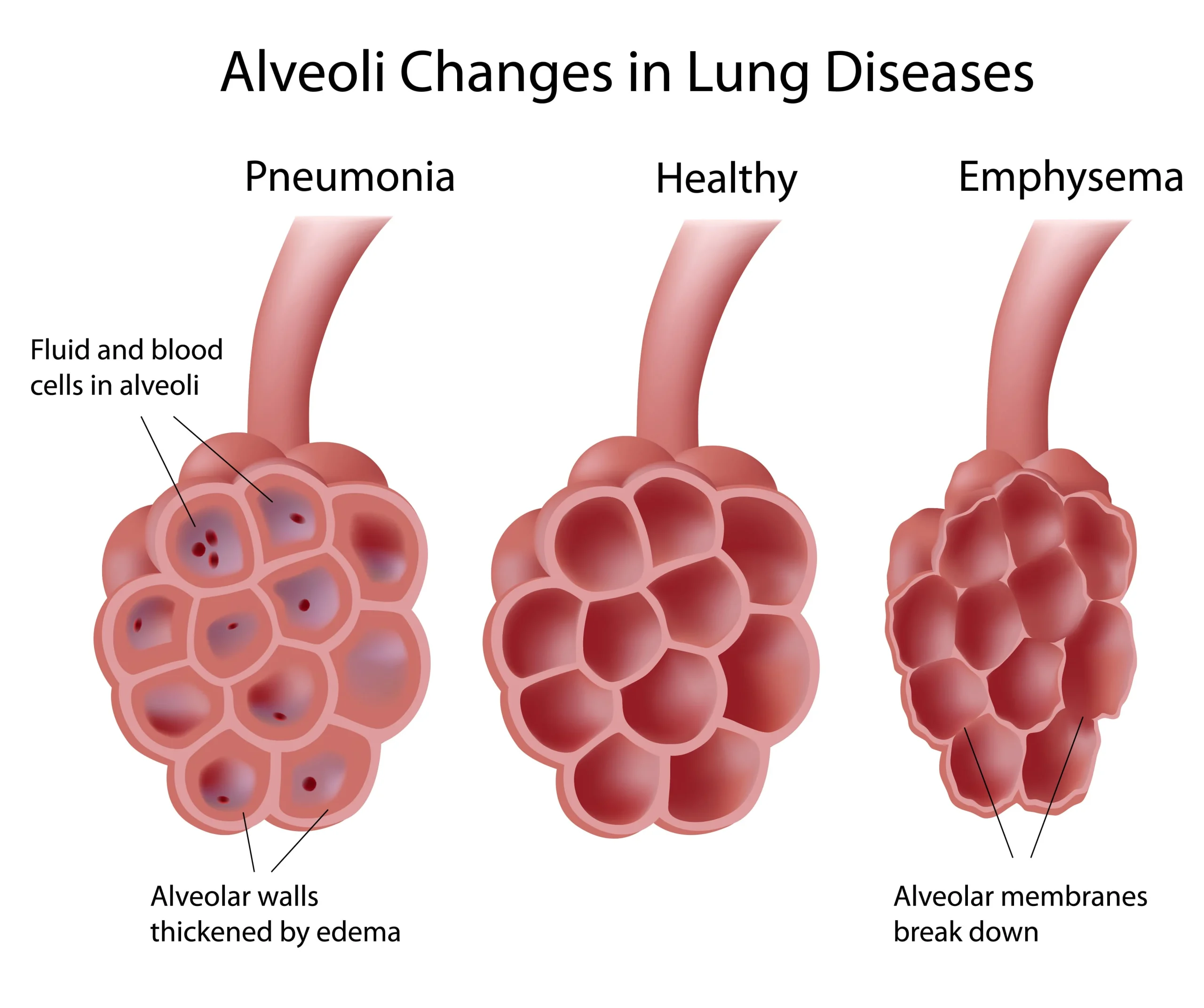 Peradangan Alveoli