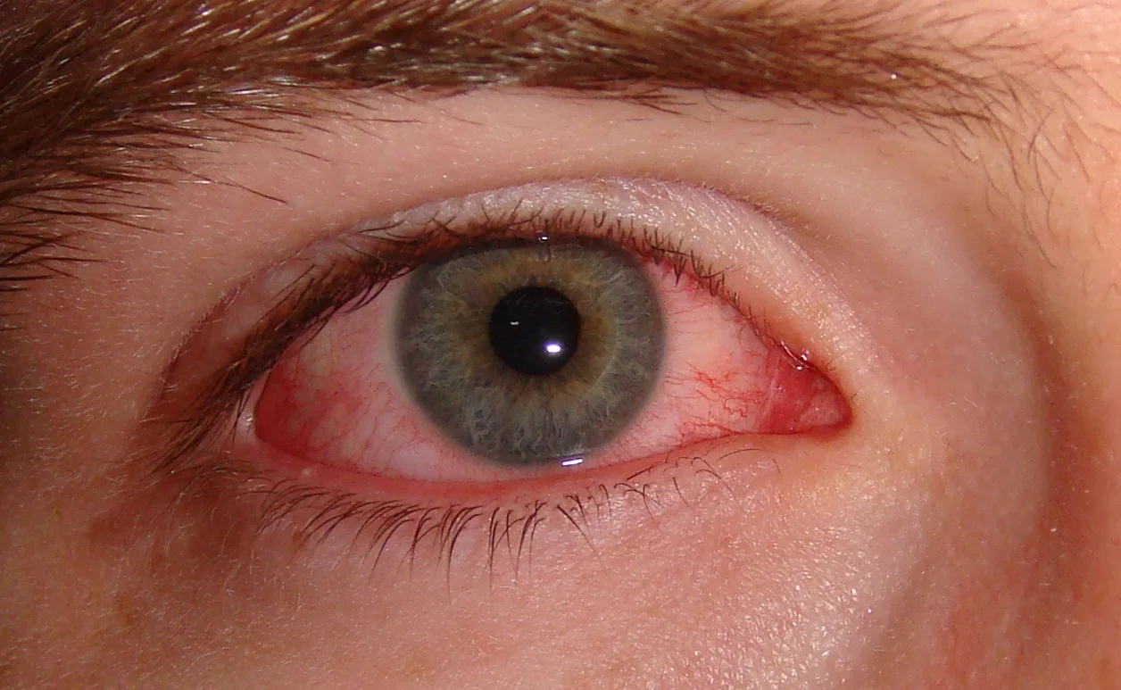 Konjungtivitis Alergi