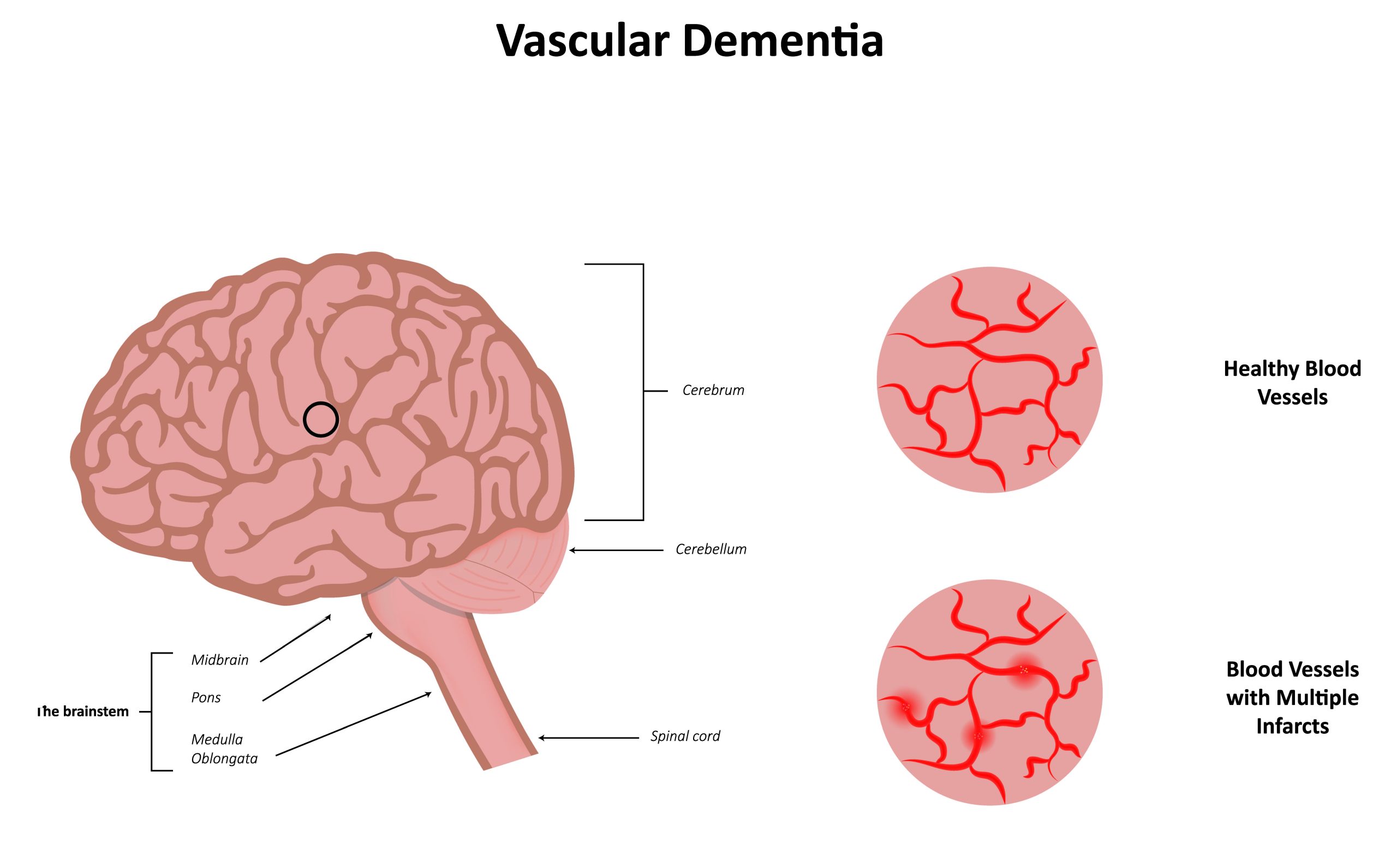 Demensia Vaskular