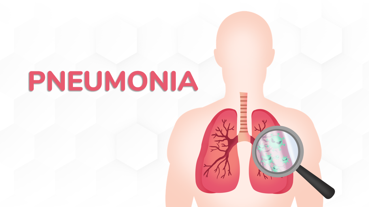 Virus Pneumonia
