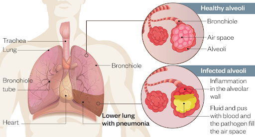 Virus Pneumonia