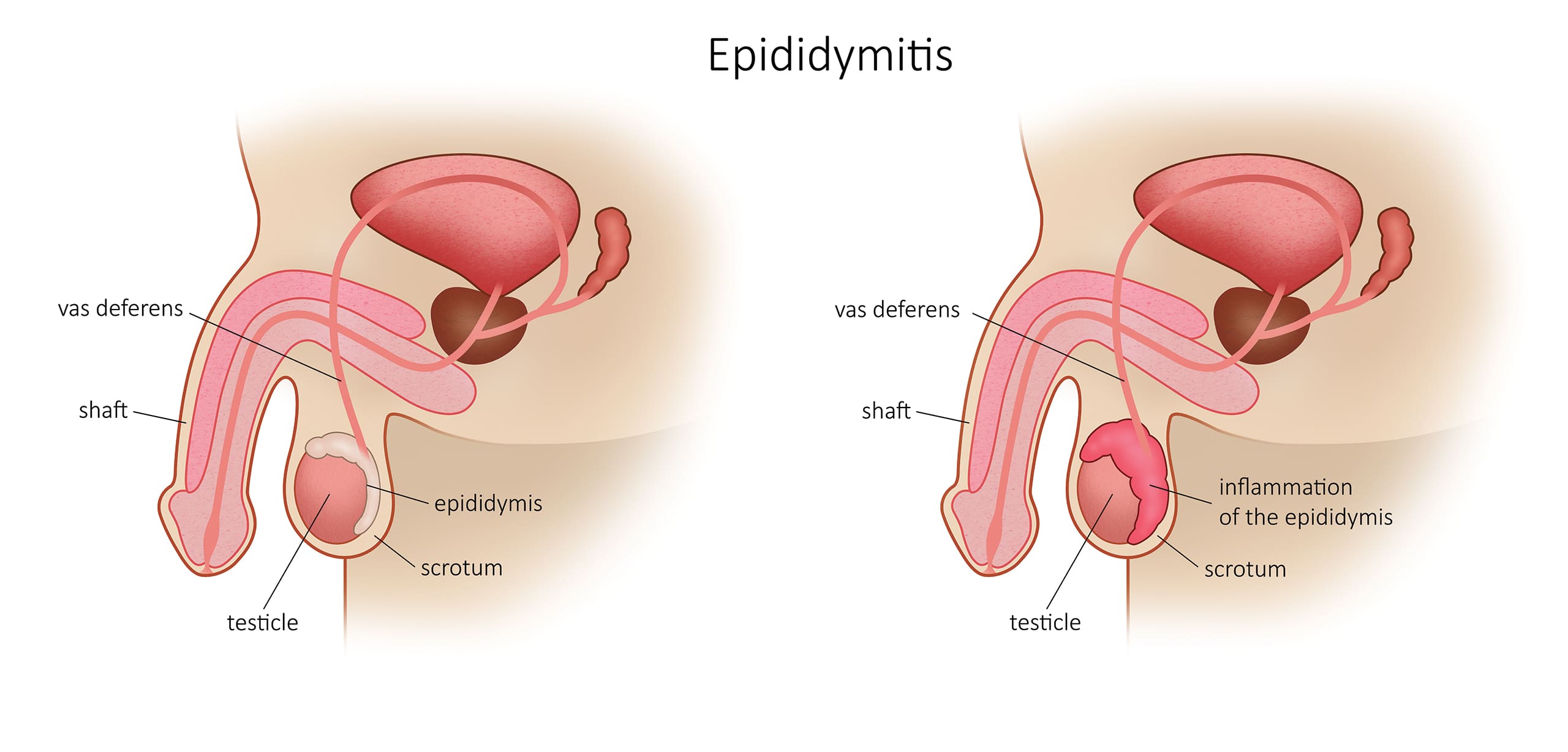 Epididimitis