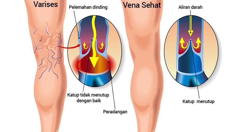 Varises Vena