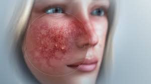 Rosacea Kronis