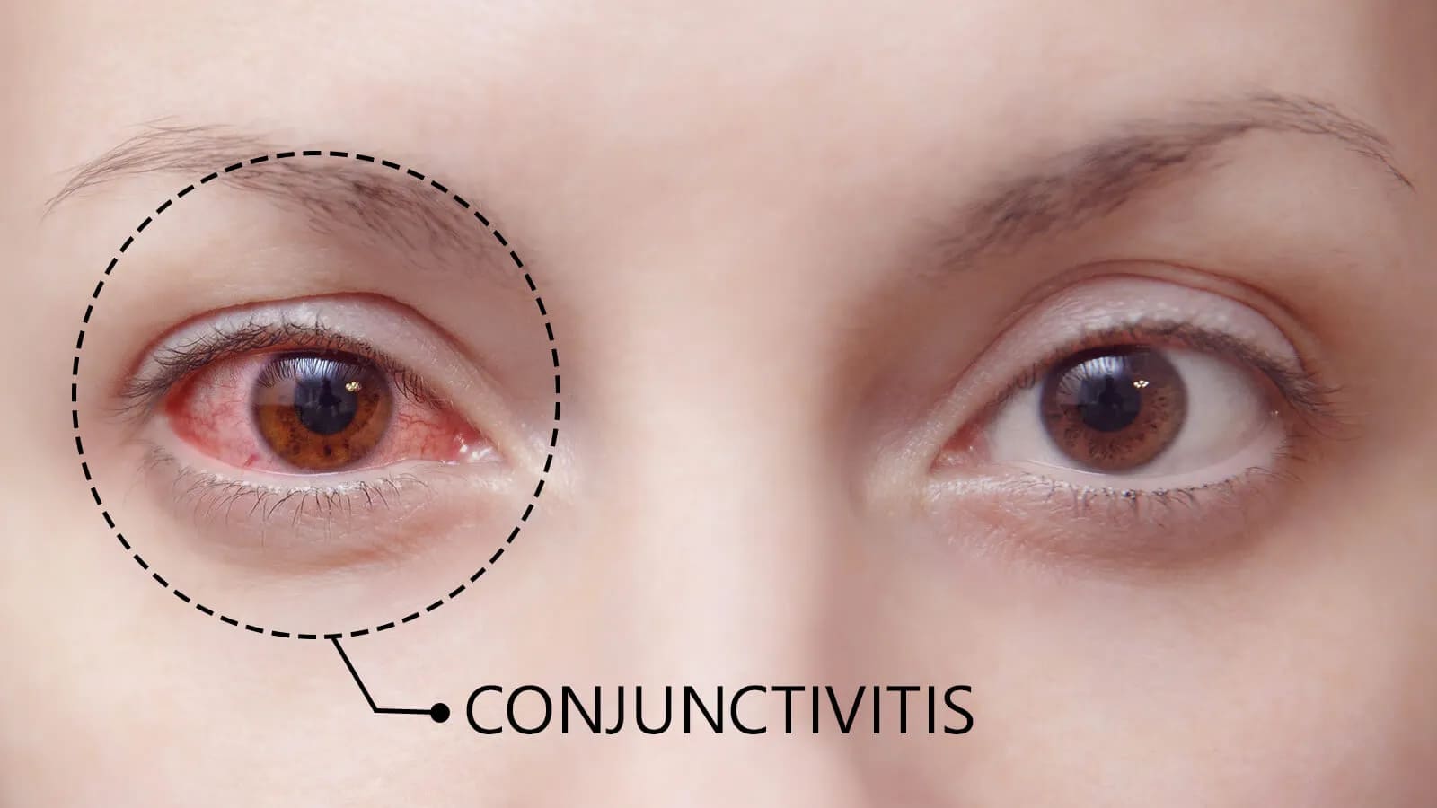 Konjungtivitis Alergi