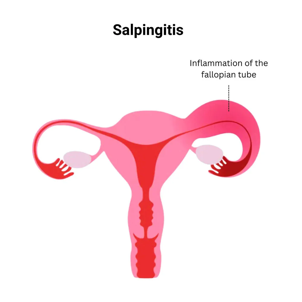 Salpingitis