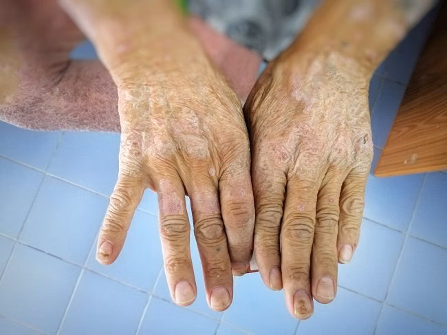 Skleroderma Sistemik