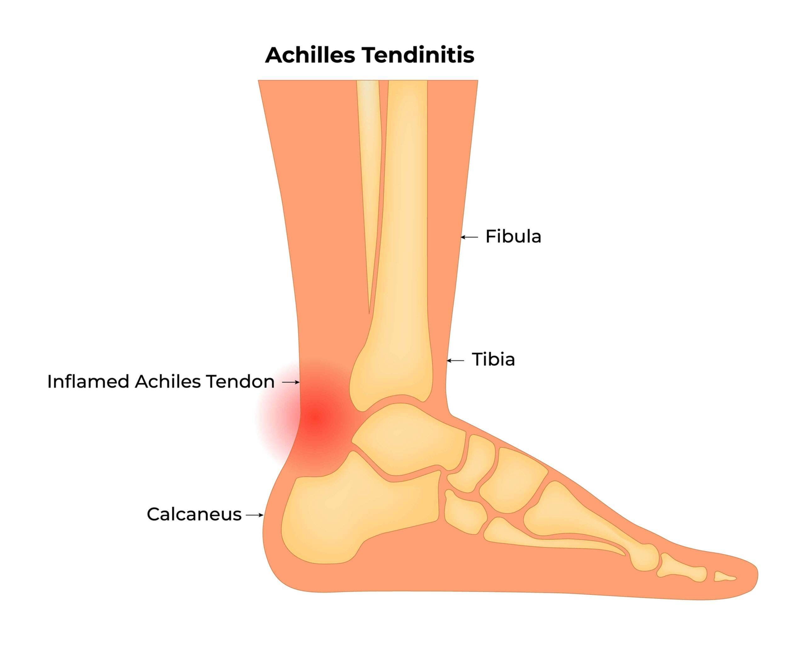 Tendon Achilles