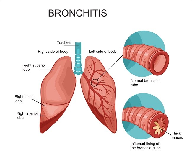 Bronkitis Kronik