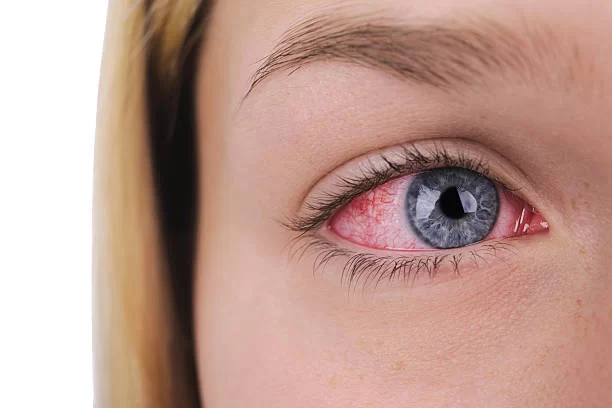 Konjungtivitis Mata