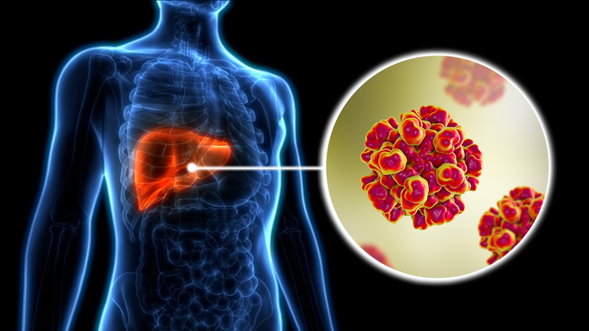 Hepatitis E