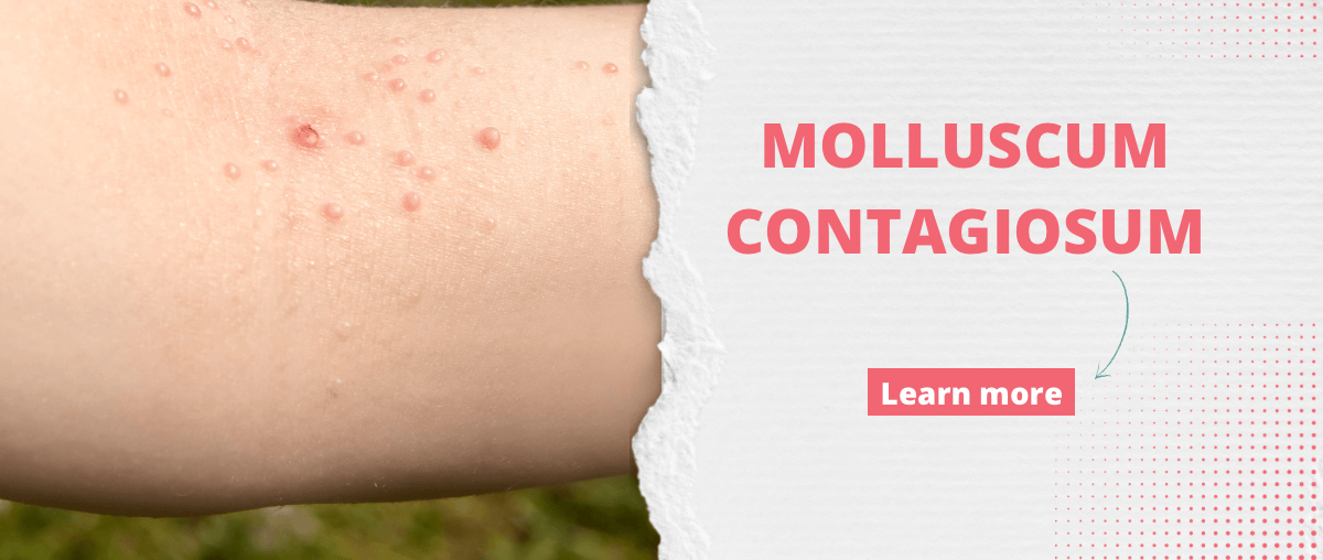 Molluscum Contagiosum