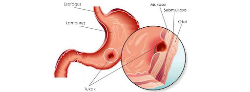 Mukosa Lambung