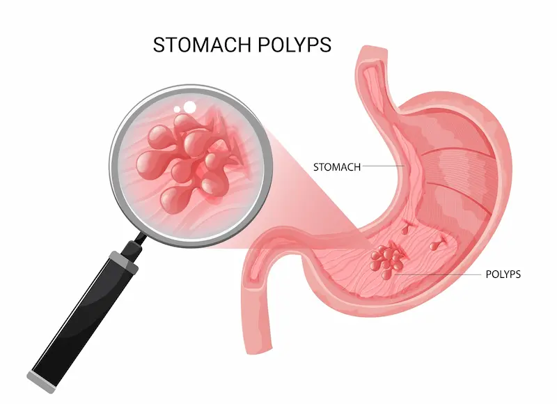 Polip Lambung