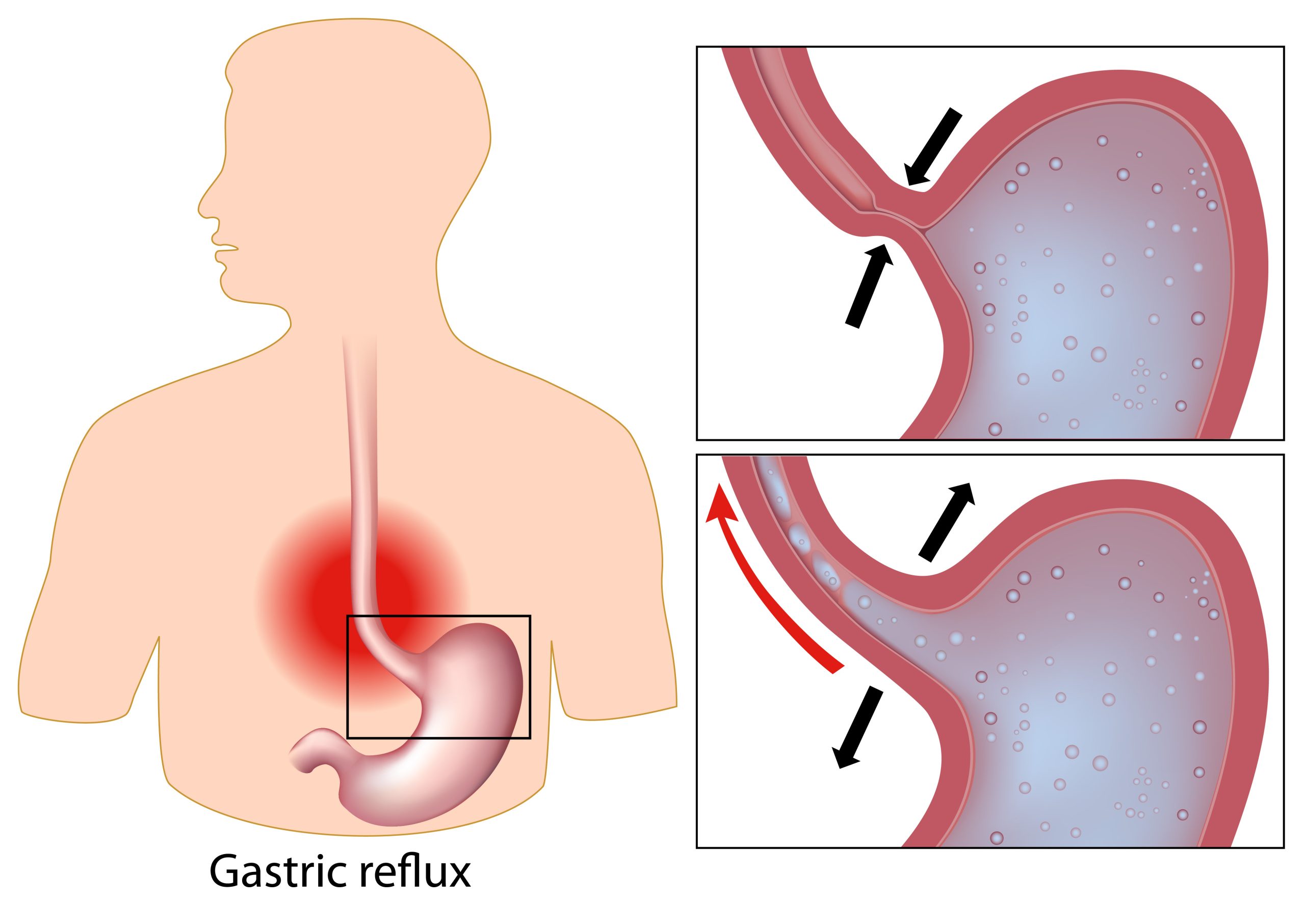 Refluks Gastroesofagus