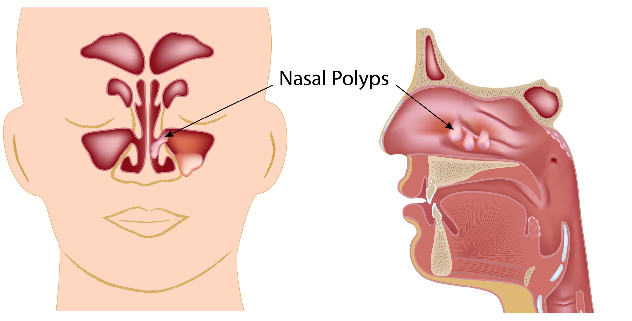 Sinonasal Polyposis