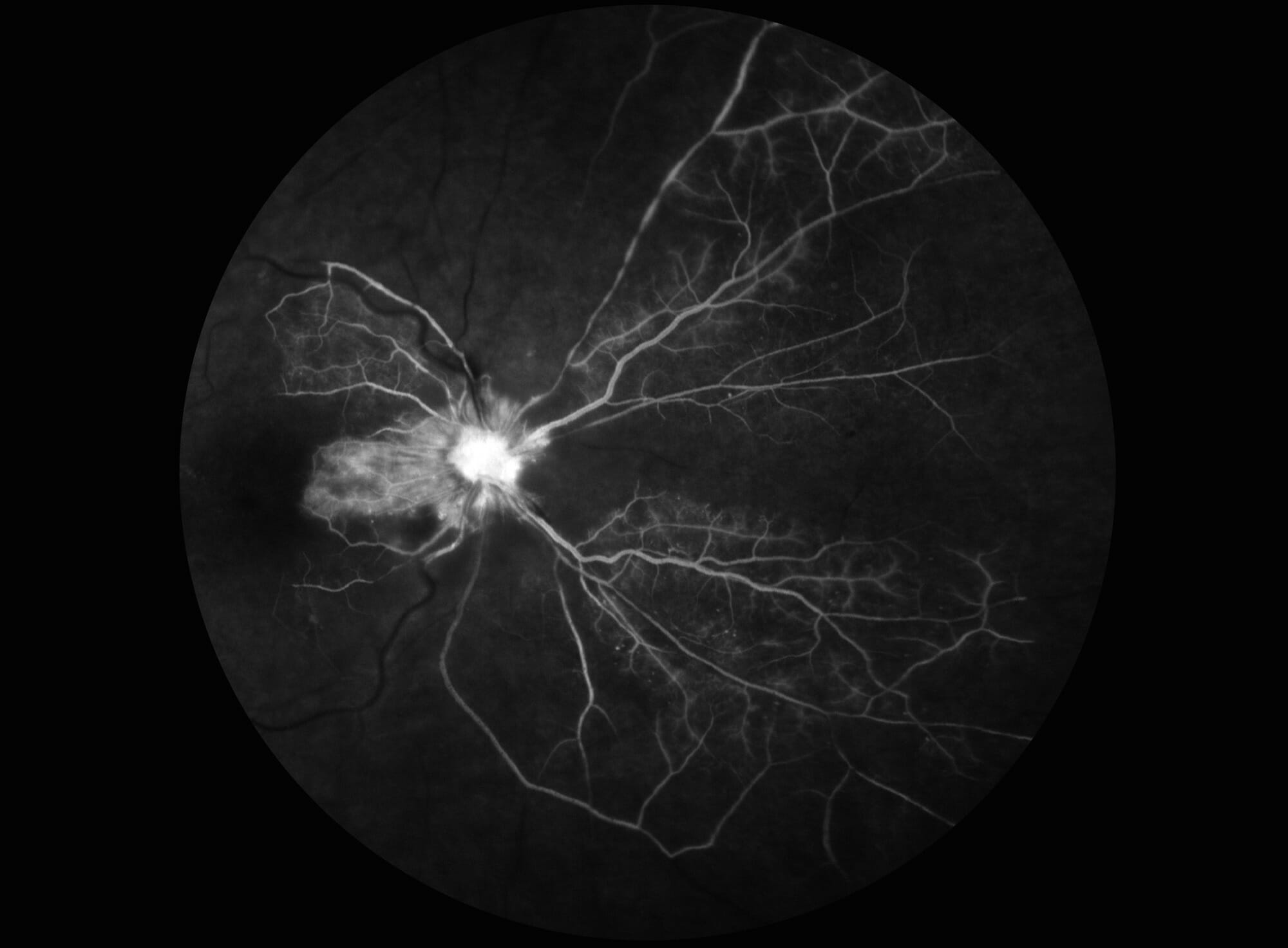 Oklusi Arteri Retina Sentral