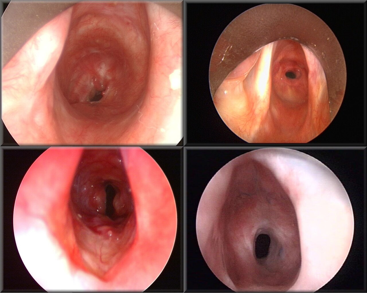 Stenosis Subglotis