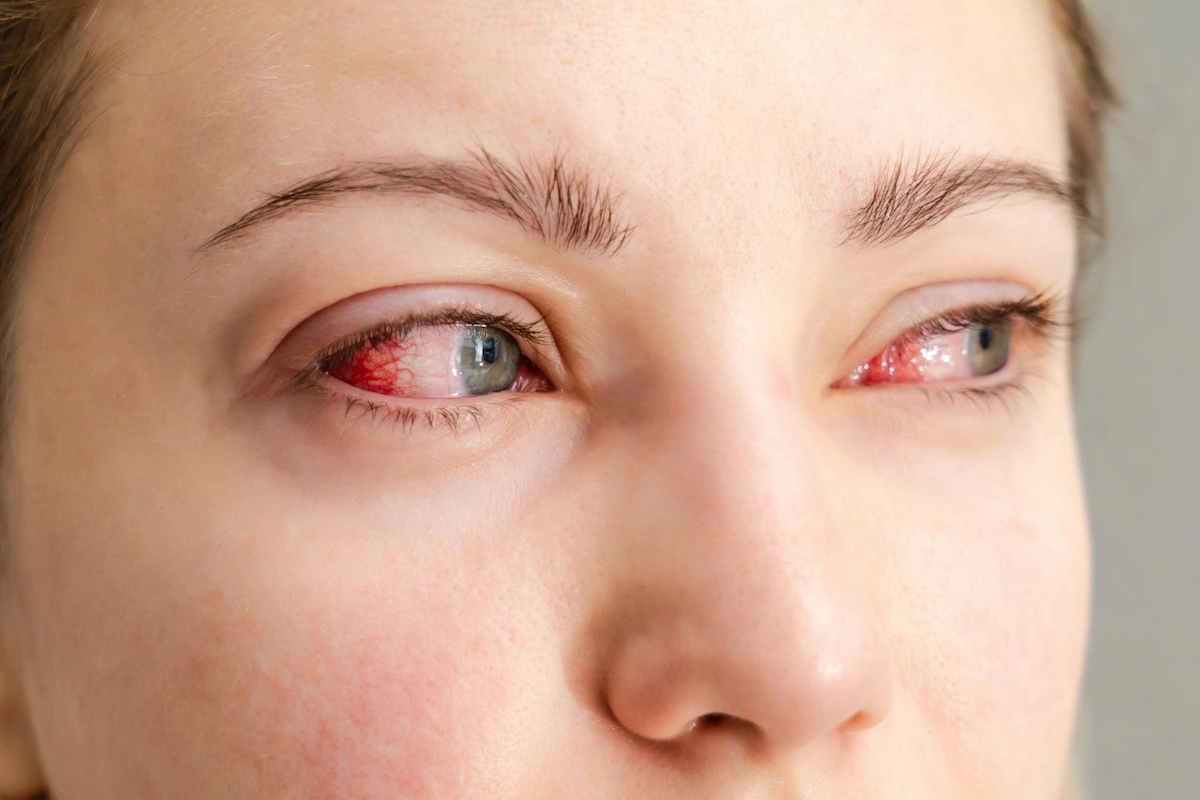 Virus Konjungtivitis