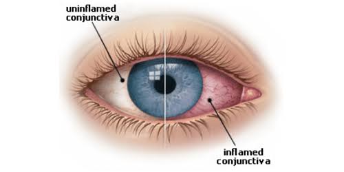 Virus Konjungtivitis