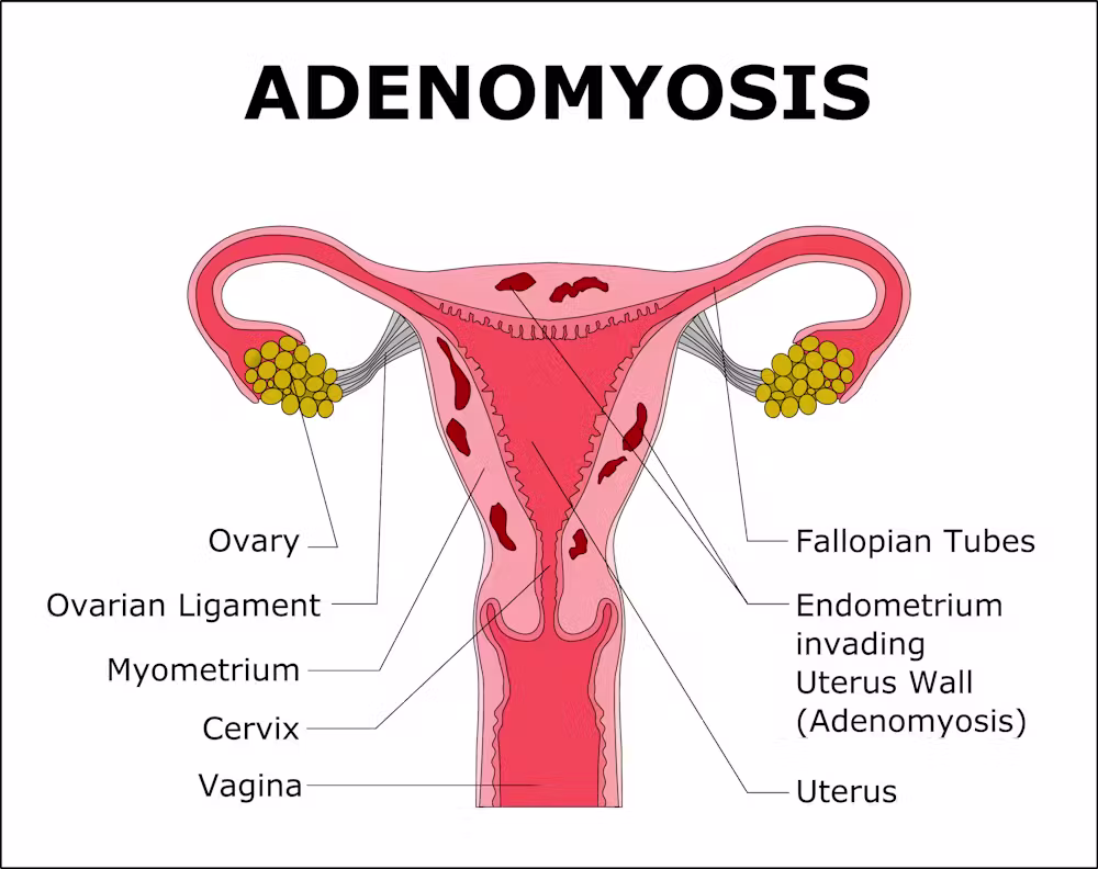 Adenomiosis