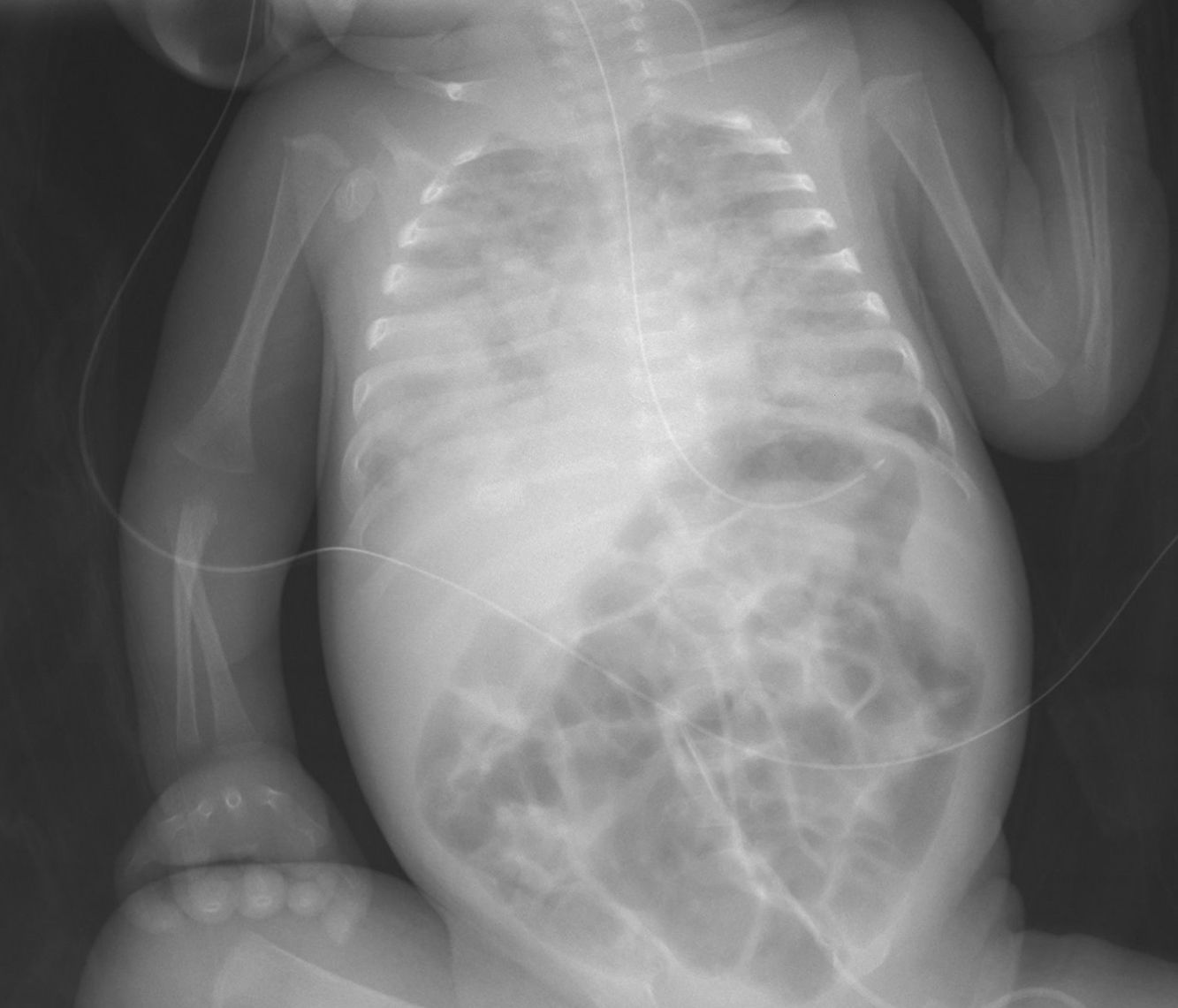 Pneumonia Neonatal