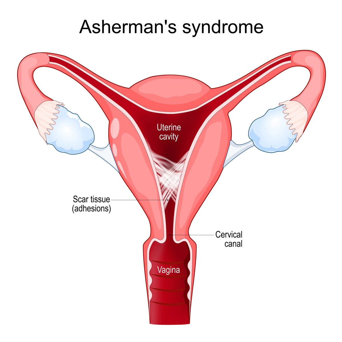 Sindrom Asherman