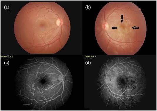 Koroiditis