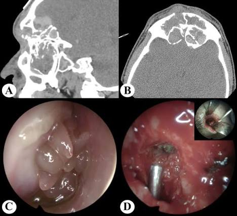 Sinonasal Polyposis